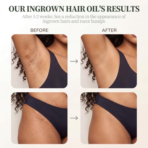 Save 50% with Code LR46R3JZ - Ingrown Hair Treatment Oil - Image 6