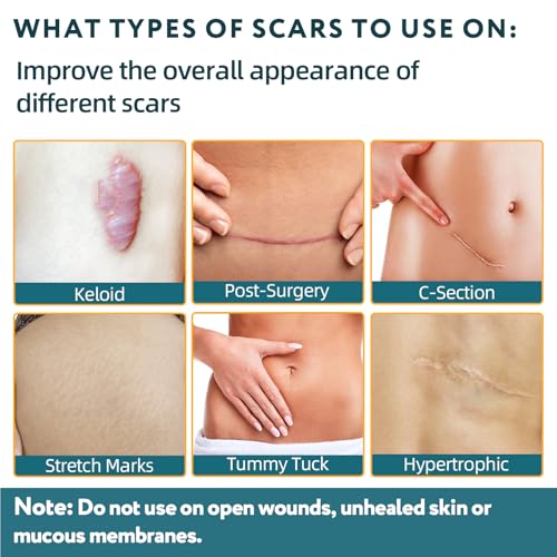 Save 38% on RWT Medical-Grade Silicone Scar Tape - Image 2