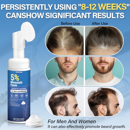 5% Minoxidil Hair Growth Foam 3-Pack for Thinning Hair - Image 2