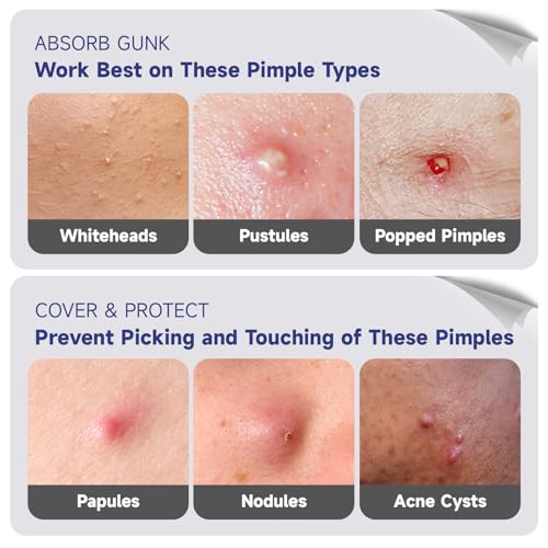 Save 24% on Cute Pink Heart Pimple Patches with Salicylic Acid - Image 6